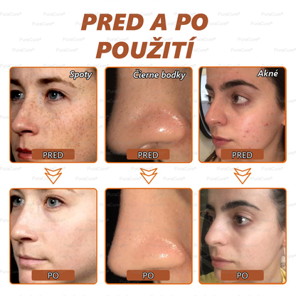 💟𝗣𝘂𝗿𝗮𝗖𝘂𝗿𝗲® Bieliaca a zosvetľujúca maska na tvár | Prírodné zložky, ktoré dlhodobo odstraňujú pigmentové škvrny, pehy a slnečné škvrny🌿🌿