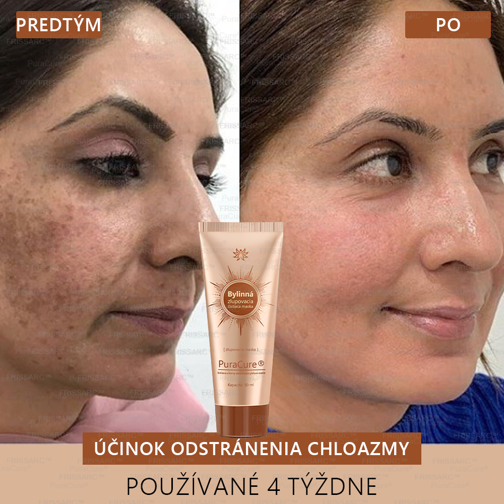 💟𝗣𝘂𝗿𝗮𝗖𝘂𝗿𝗲® Bieliaca a zosvetľujúca maska na tvár | Prírodné zložky, ktoré dlhodobo odstraňujú pigmentové škvrny, pehy a slnečné škvrny🌿🌿
