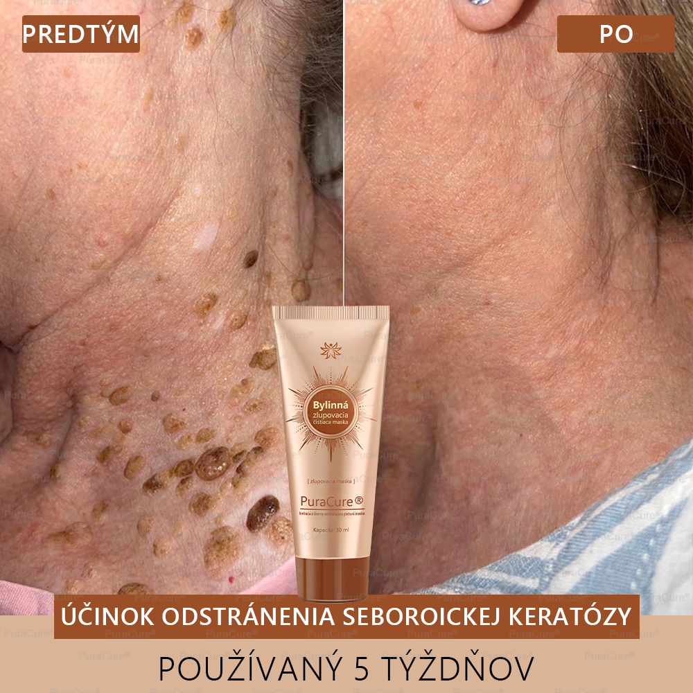 💟𝗣𝘂𝗿𝗮𝗖𝘂𝗿𝗲® Bieliaca a zosvetľujúca maska na tvár | Prírodné zložky, ktoré dlhodobo odstraňujú pigmentové škvrny, pehy a slnečné škvrny🌿🌿