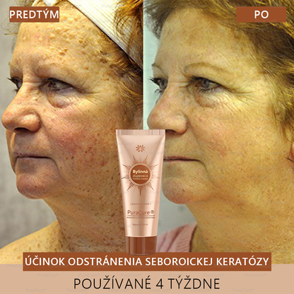 💟𝗣𝘂𝗿𝗮𝗖𝘂𝗿𝗲® Bieliaca a zosvetľujúca maska na tvár | Prírodné zložky, ktoré dlhodobo odstraňujú pigmentové škvrny, pehy a slnečné škvrny🌿🌿