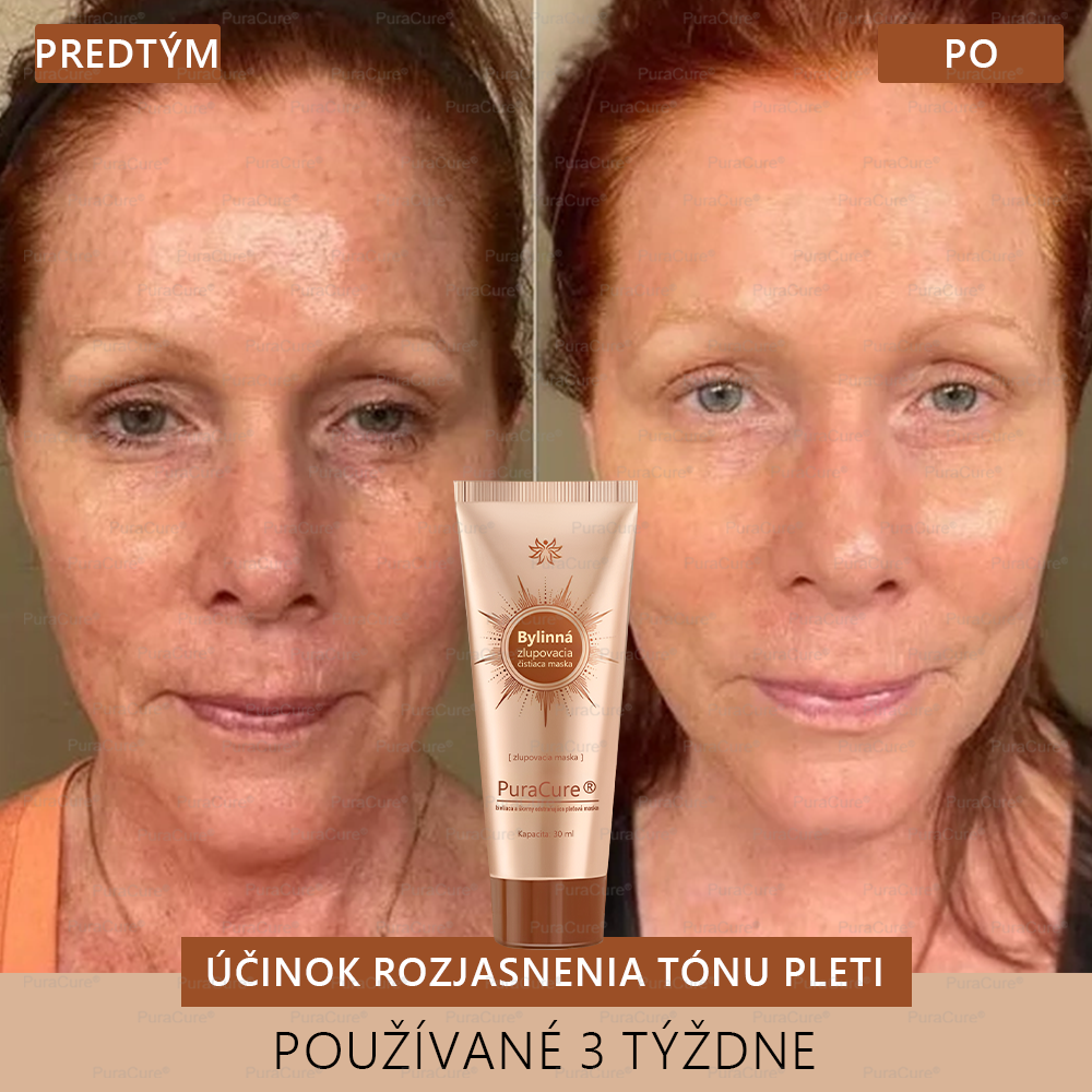 💟𝗣𝘂𝗿𝗮𝗖𝘂𝗿𝗲® Bieliaca a zosvetľujúca maska na tvár | Prírodné zložky, ktoré dlhodobo odstraňujú pigmentové škvrny, pehy a slnečné škvrny🌿🌿